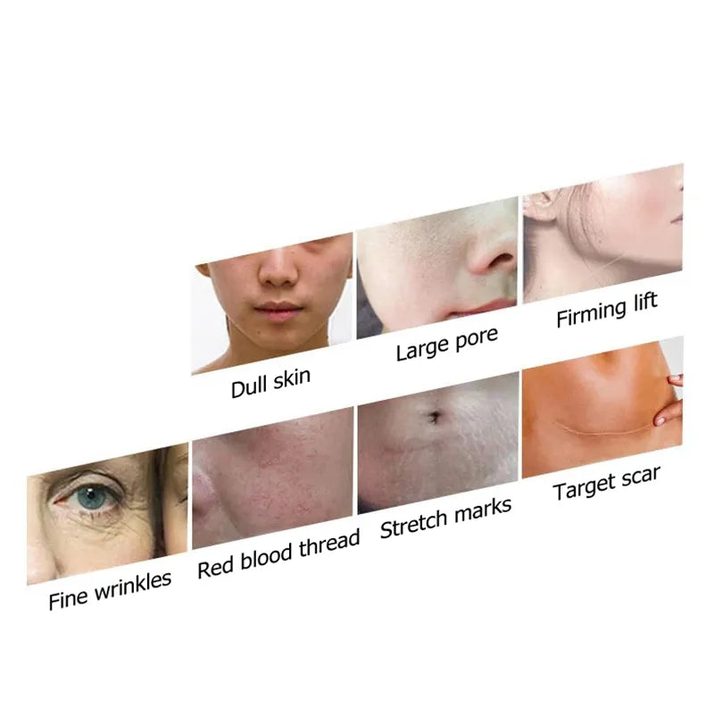 2024 Skin Tightening Fractional Gold RF Microneedle Machine – Professional Collagen Stimulation & Rejuvenation