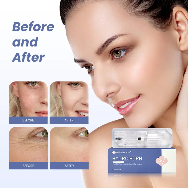 Meso Secret Improved Acne Scarring Injection – Hydro PDRN Skinbooster