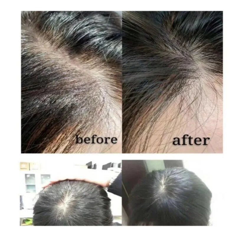 High Quality BCN Capillum – Peptide Advanced Hair Loss Cocktail Therapy for Hair Regrowth