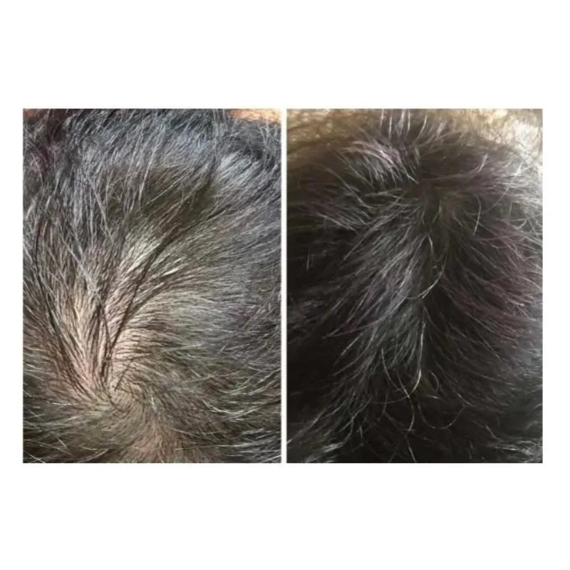 High Quality BCN Capillum – Peptide Advanced Hair Loss Cocktail Therapy for Hair Regrowth