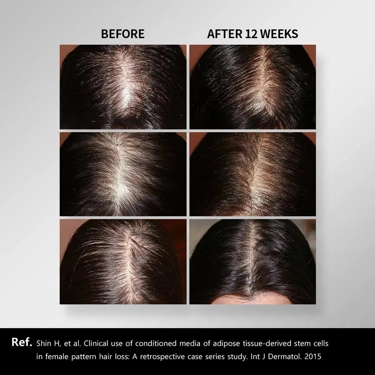 Inno-TDS Hair Vital Loss Control Treatment for Male Pattern Baldness & Androgenic Alopecia