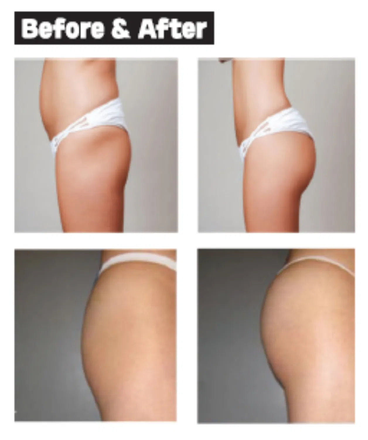 Korea Wanna Fill Sedy Fill 7D Gana Hyaluronic Acid Dermal Filler – Body Enhancement for Breast, Buttock, Penis Enlargement (60cc / 50ml / 10ml)