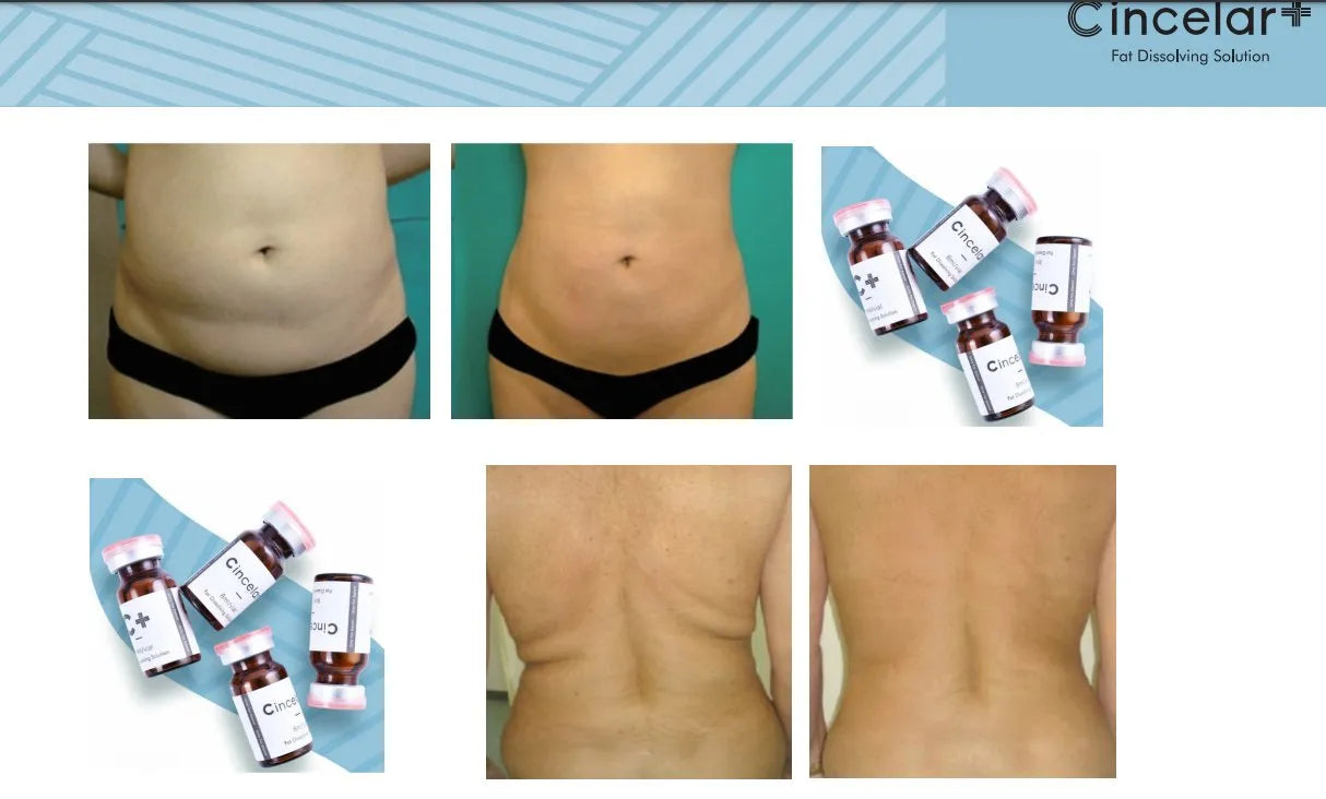 New Generation Cincelar+ Fat Dissolving Solution – Painless, Safe & Highly Effective