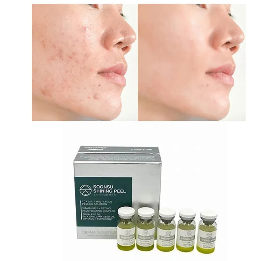 New Soonsu Shining TCA + Retinol Peeling – Anti-Acne Chemical Peel Facial Treatment
