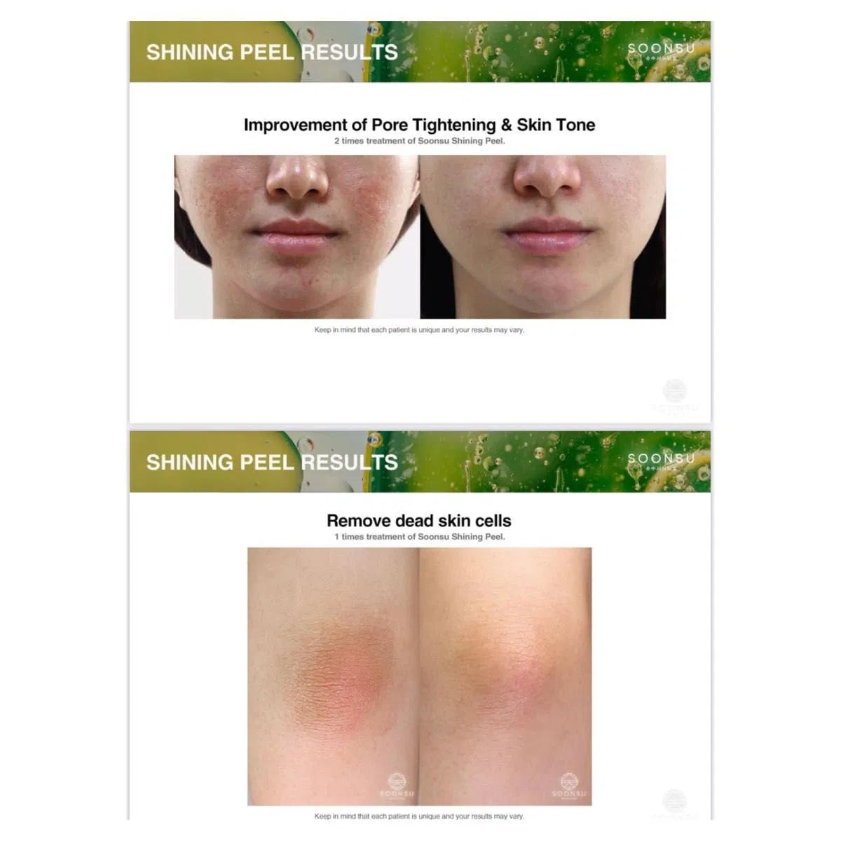 New Soonsu Shining TCA + Retinol Peeling – Anti-Acne Chemical Peel Facial Treatment