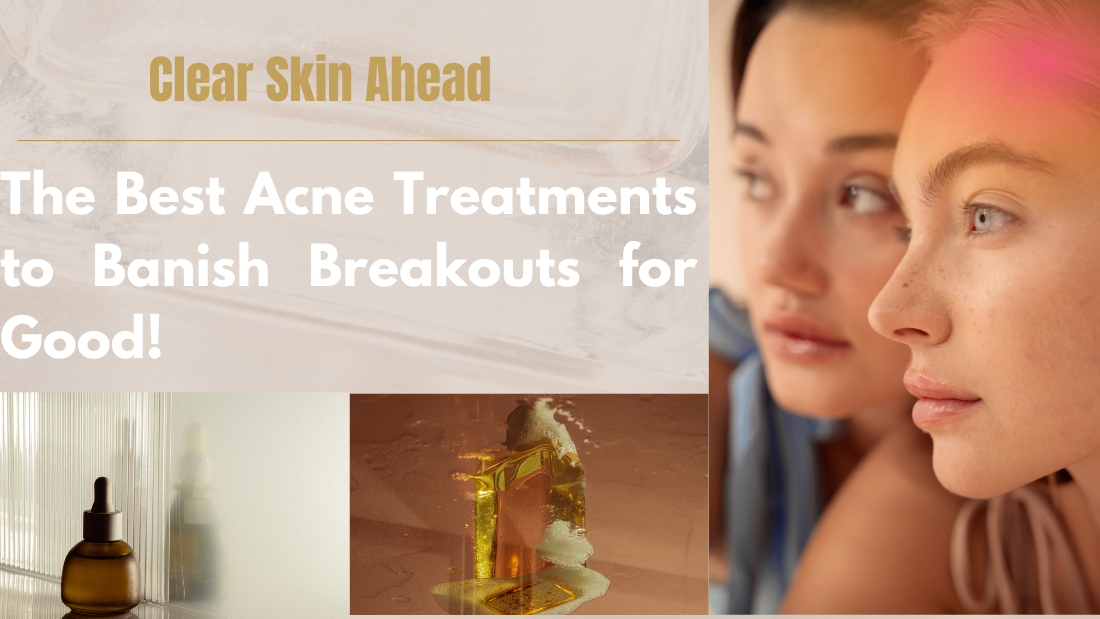 Clear Skin Ahead: The Best Acne Treatments to Banish Breakouts for Good!