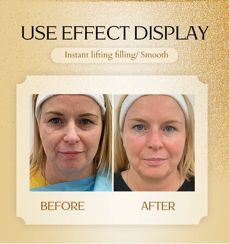 Gold Skin Care Facial Collagen Thread Lift – Protein-Infused Thread Therapy for Skin Lifting & Anti-Aging