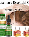 EELHOE Rosemary Essential Oil For Hair Growth 30ml