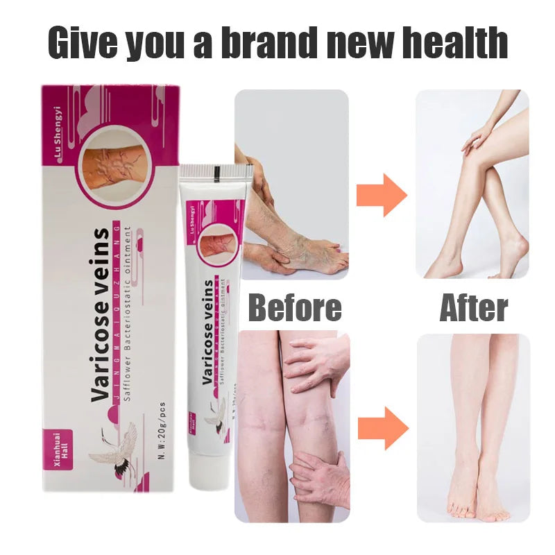 Varicose Vein Treat Cream Varicose Vein Vasculitis Ointment Relieves Spider Leg Vein Pain Phlebitis Medical Plaster Health Care