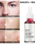 Facial Serum  Peeling Solutions Anti Acne Serum Reduce Wrinkle