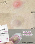 RtopR Acne Pimple Patch 24 patches