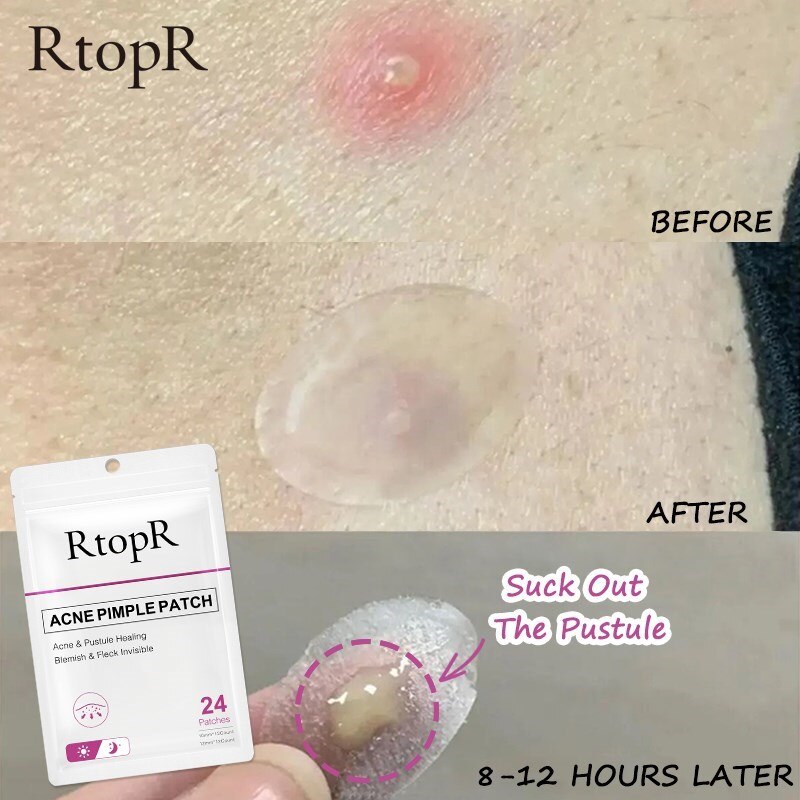 RtopR Acne Pimple Patch 24 patches