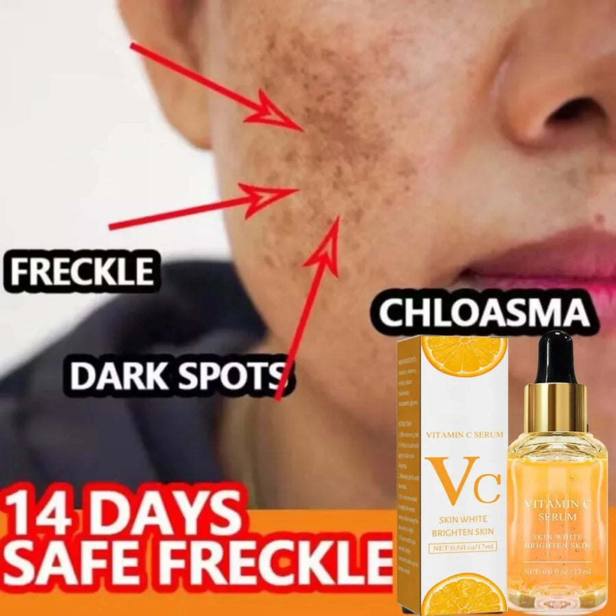 Vitamin C Whitening Dark Spots Freckles Fade Melanin RetinolSkincare 17ml