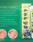 MIAO YAO QI YANG JING Natural Psoriasis Herbal Cream and Eczema Plaster