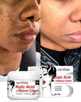 Kojic Acid Retinol Cream Skin Whitening Cream Remove Dark Spots Facial Skin Care