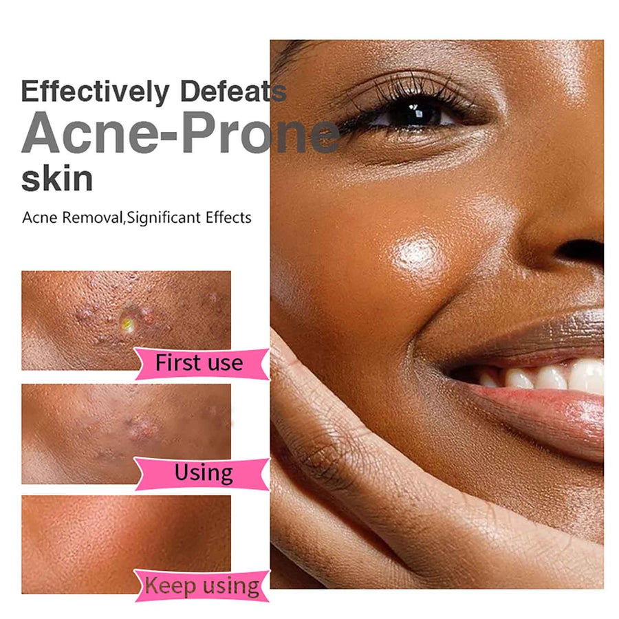 AILKE Organic Salicylic Acid Acne Cream