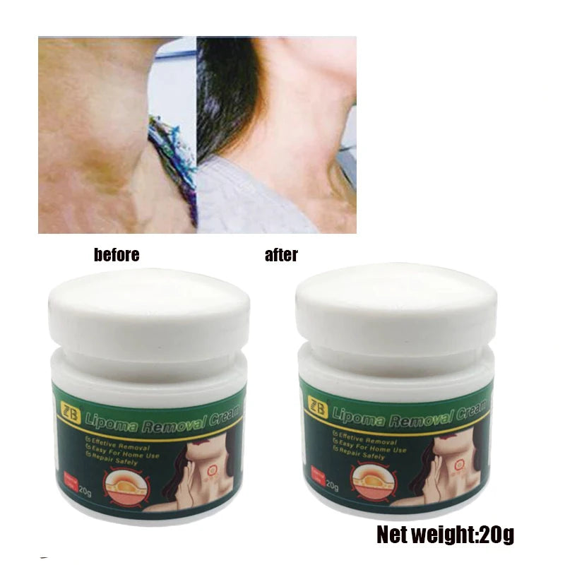 20G Herb Lymphatic Ointment Relieves Cervical Lymph Behind Auricular Lymph And Inguinal Lymph And Promotes Human Body Health