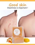 Skin Help Zone Turmeric Face Soap Acne Treatment Lighten Dark Spots Black Skin  Handmade 110g