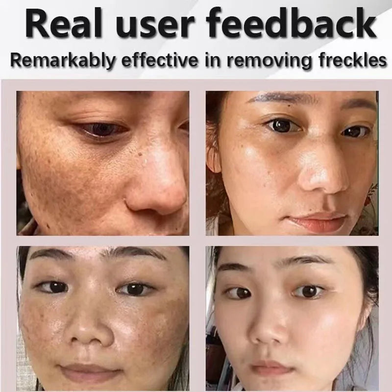 Powerful Dark Spot Remover Whitening Cream Remove Melasma Marks Lighten Melanin Improve Dull Brighten Skin Care Korean 30ml