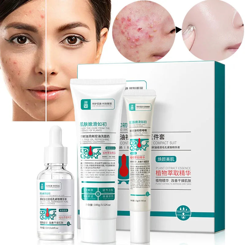 Herbal Acne Removal Face Cream Anti-Acne Mark Facial Care Set 100gm