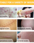 Stretch Marks Remove Acne Scar Treatment Cream