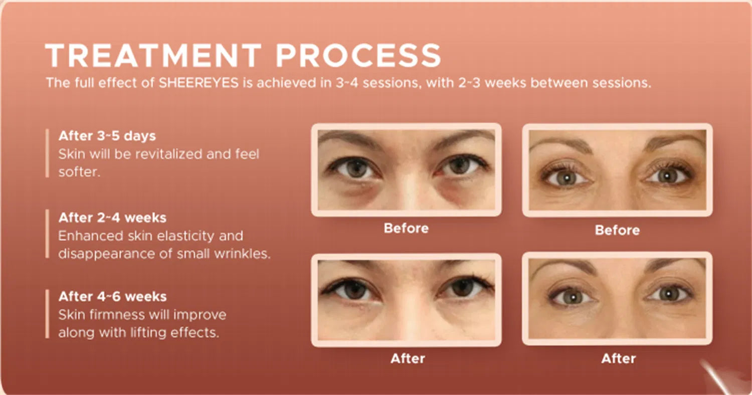 Wholesale Price PN Booster Sheer Eyes Polynucleotide Dark Circle & Eye Bag Treatment for Under-Eye Wrinkles – Richesse, Lumi, Ami Eyes