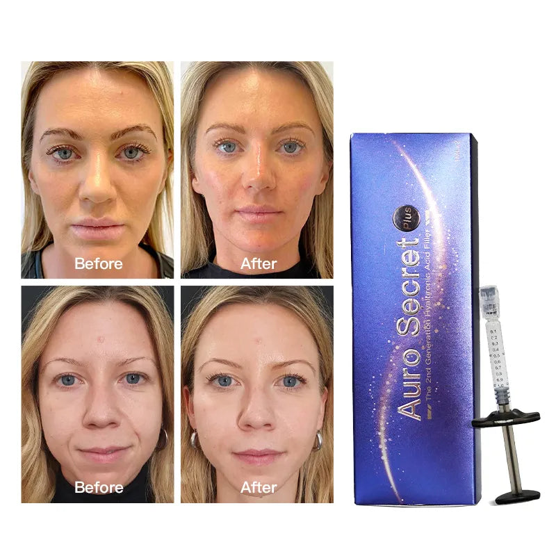 Upgraded 1ml Face & Lip Cross-Linked Hyaluronic Acid Filler – Enhanced Stability & Hydration