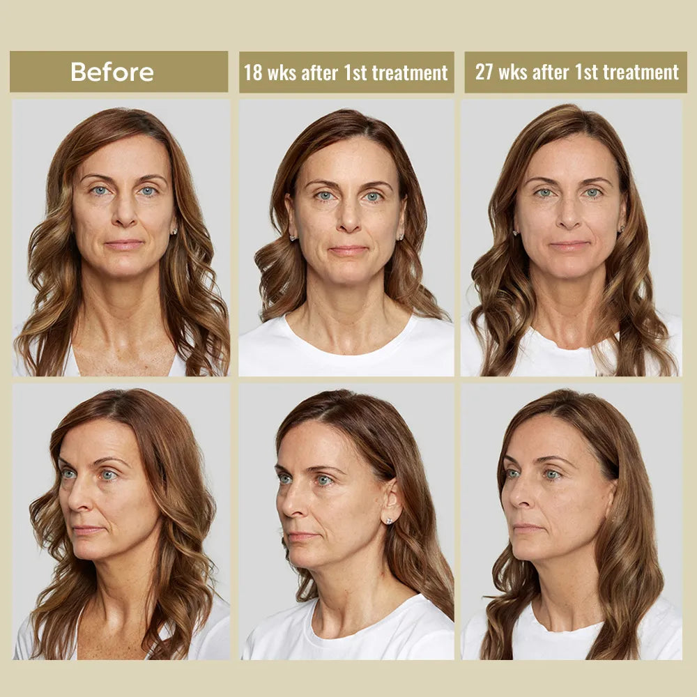 5ml Anti-Wrinkle Injection Fast Effect PLLA Filler – Rapid Collagen Stimulating Solution